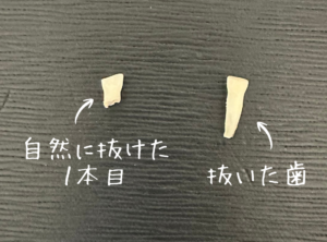 抜けた歯
